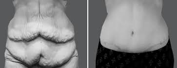 loose skin removal surgery