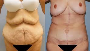 body contouring after weight loss