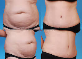 free tummy tuck after weight loss surgery