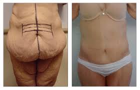 plastic surgery after bariatric surgery