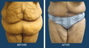 skin surgery after weight loss