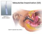 artificial insemination