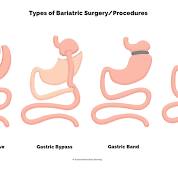 bariatric surgeries
