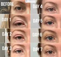 eyelid surgery blepharoplasty