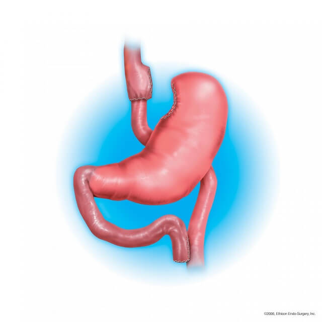 gastric bypass surgery