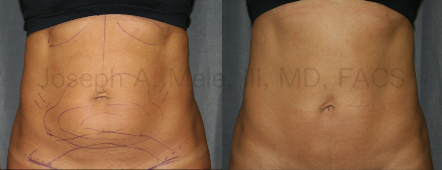 tummy tuck abdominoplasty