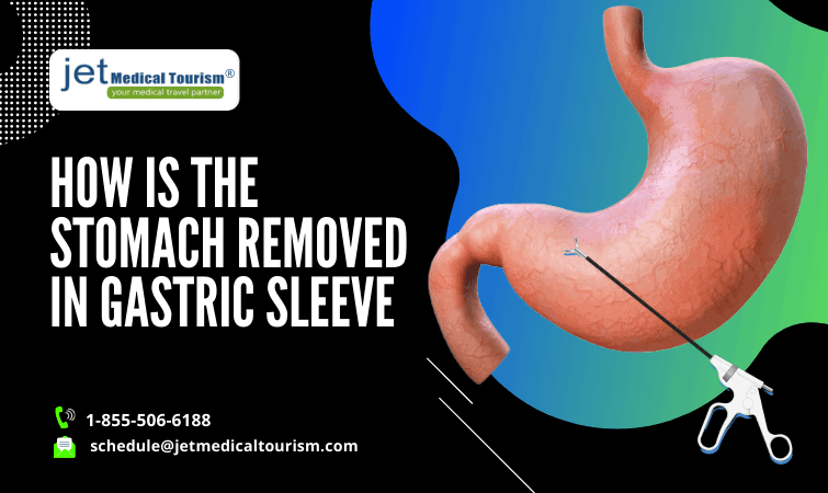 gastric sleeve stomach