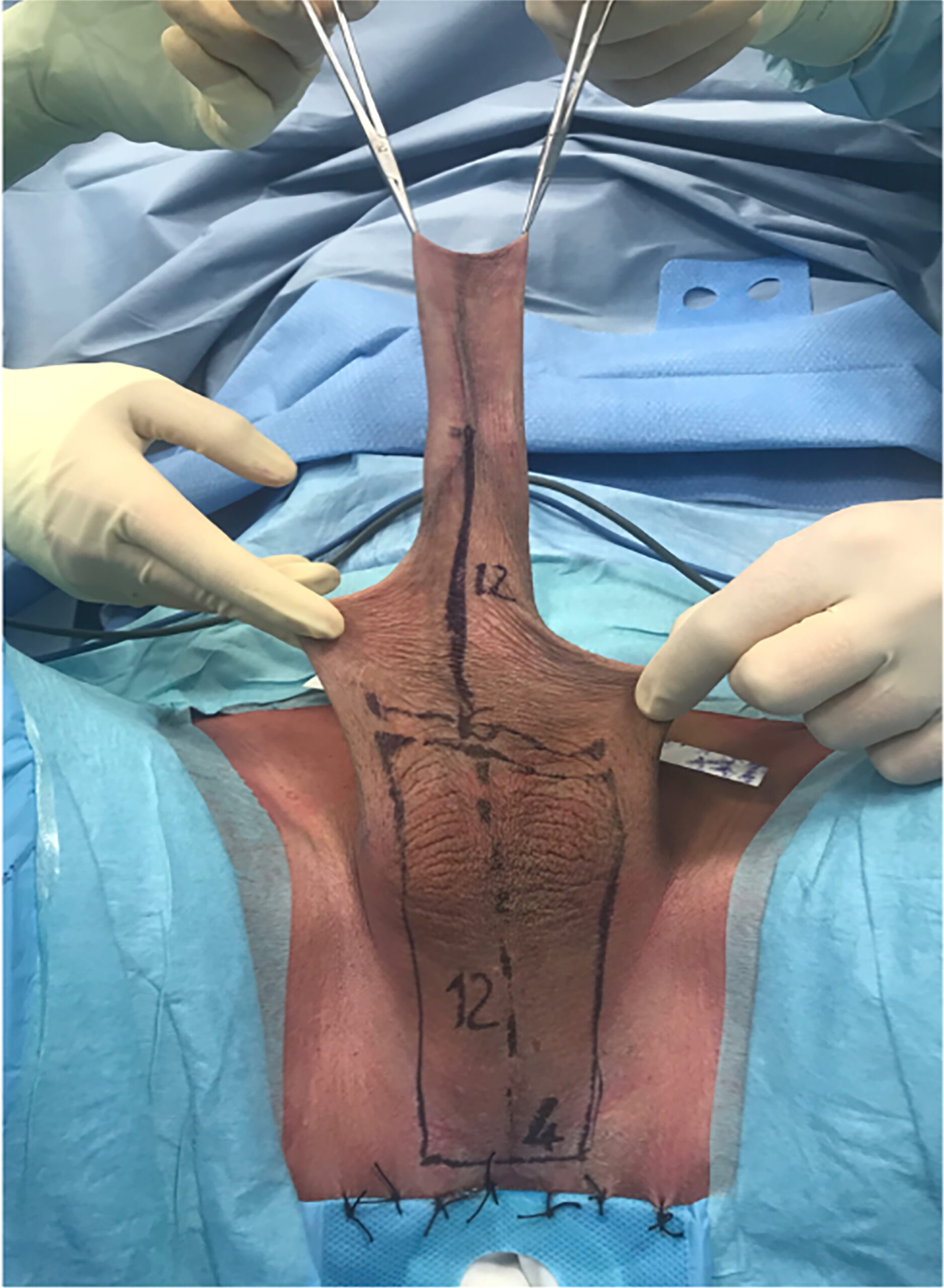 labia reconstruction