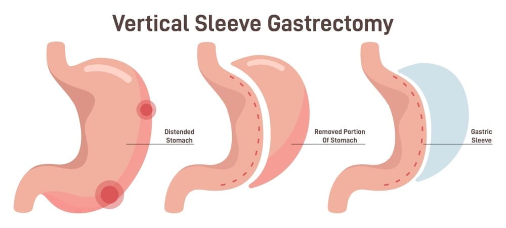 gastric sleeve