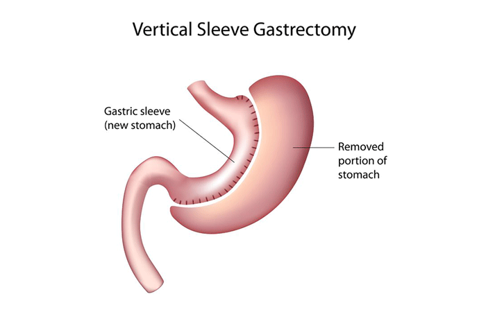 gastric sleeve stomach