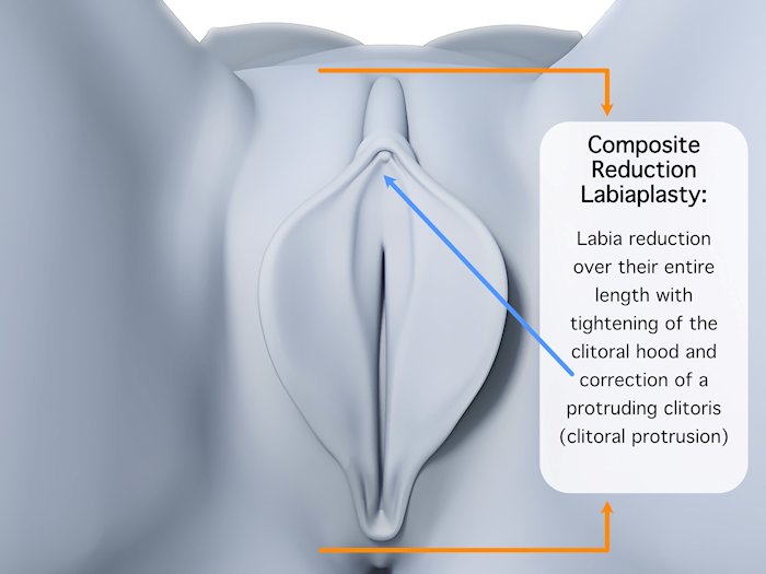 labia reconstruction