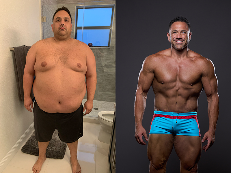 fat loss surgery
