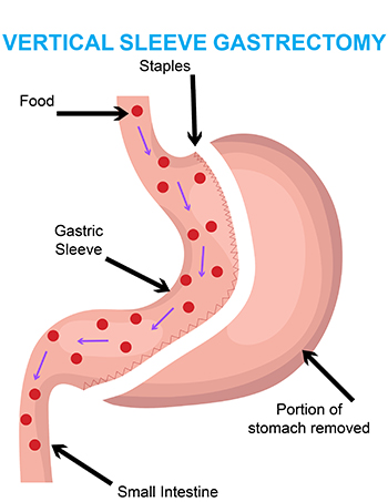 gastric bypass