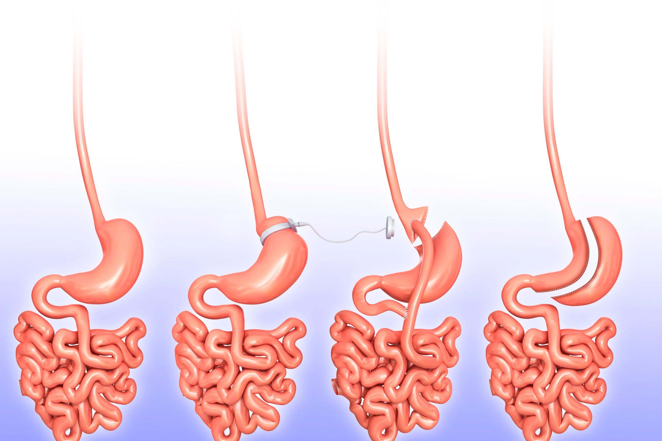 gastric bypass sleeve surgery