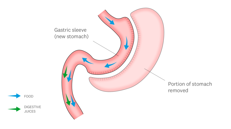 gastric sleeve operation