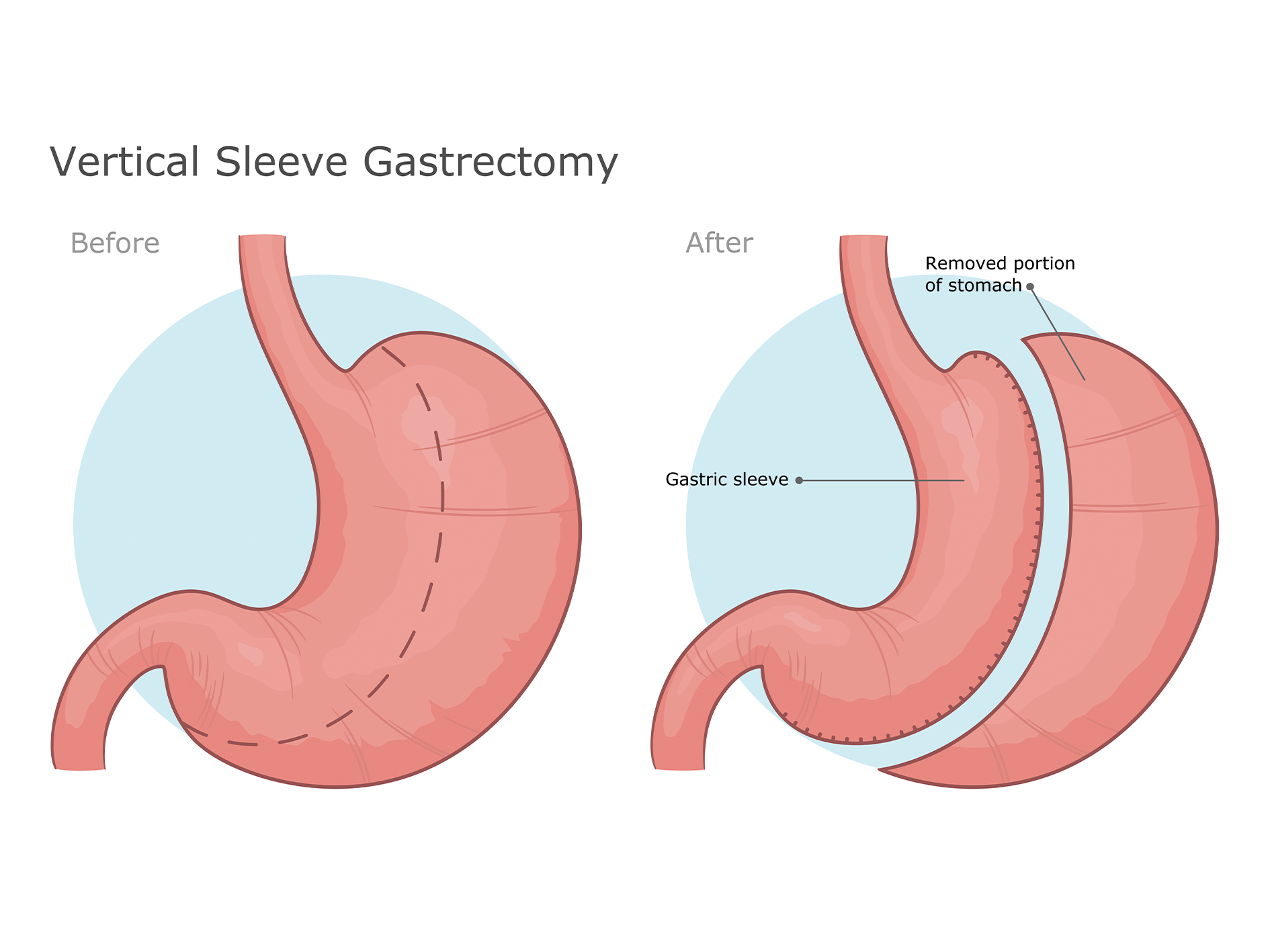 stomach sleeve operation
