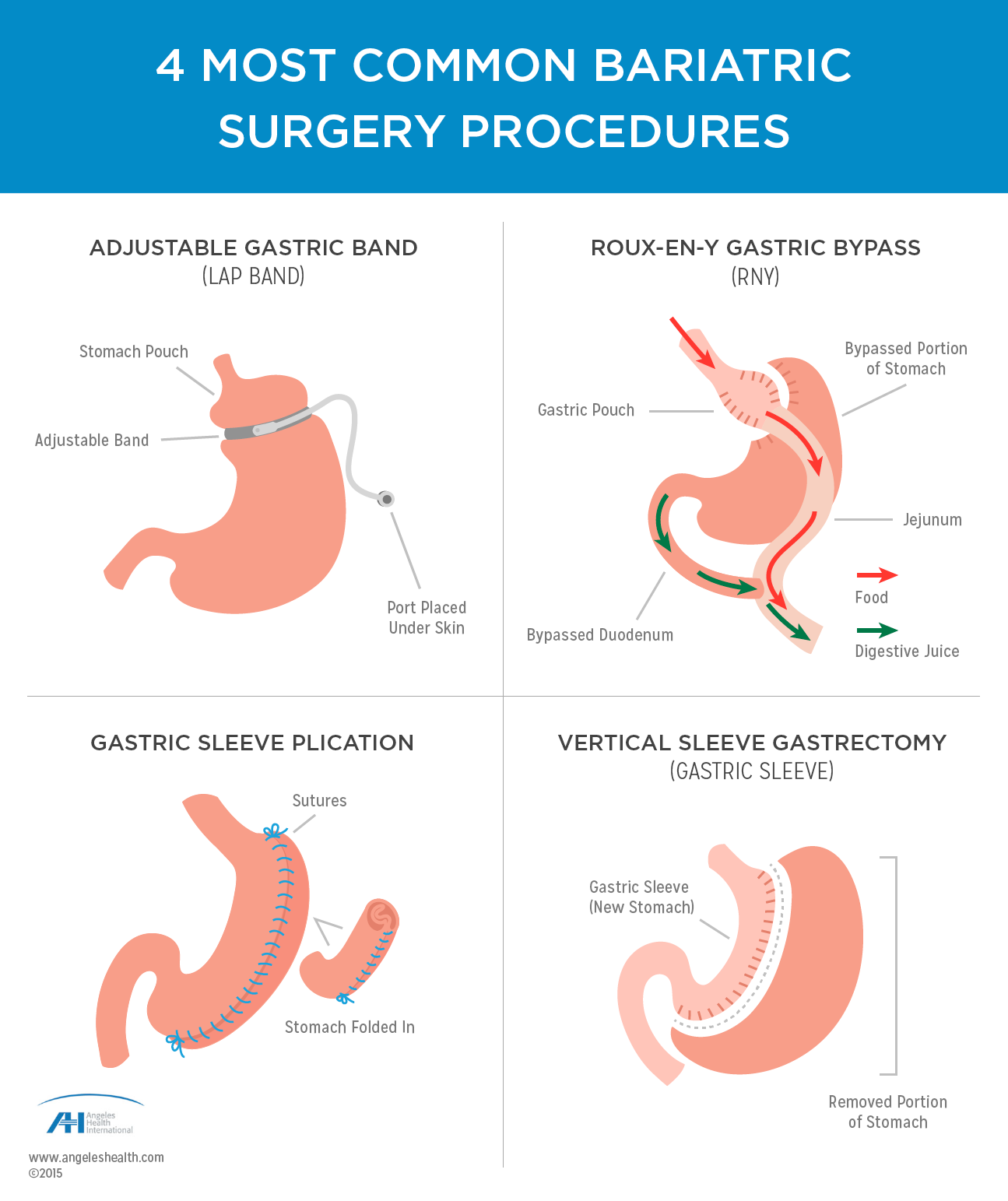 surgical weight loss