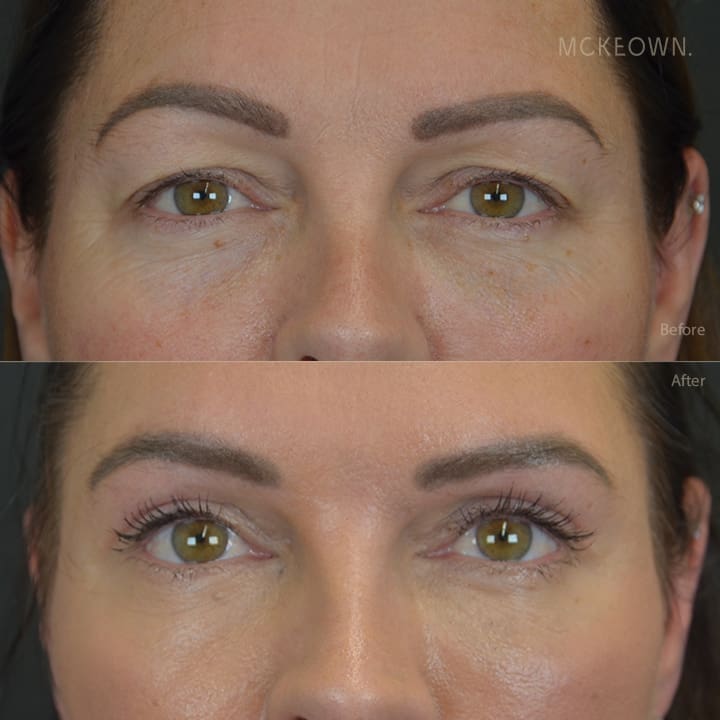 eyelid blepharoplasty