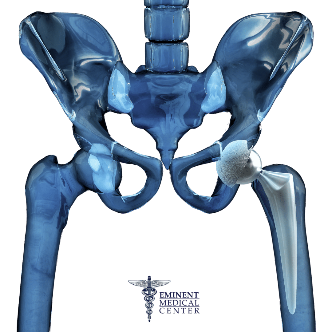 hip replacement surgeons