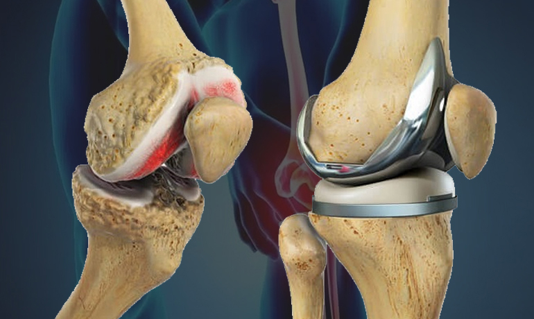knee replacement