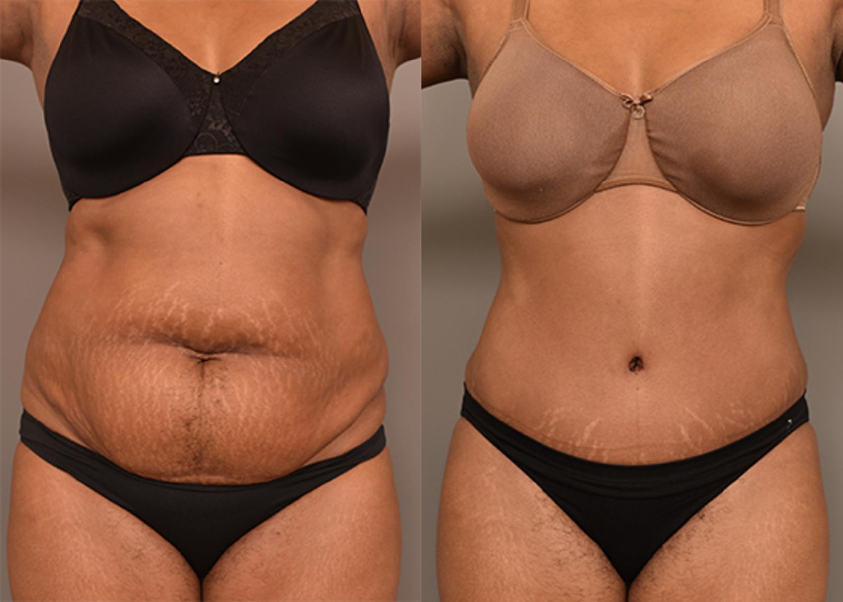 tummy tuck cost