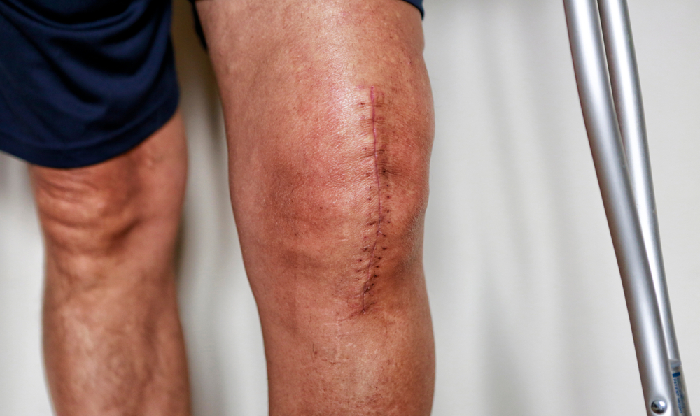 full knee replacement