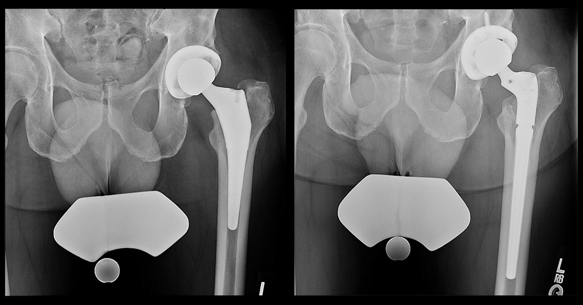 hip operations