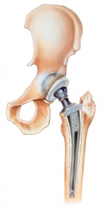 hip replacement