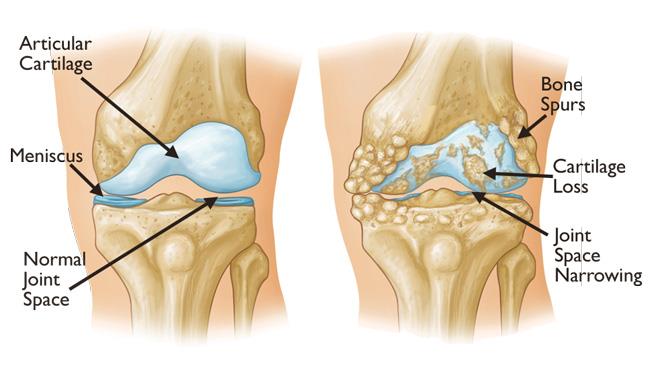 total knee replacement
