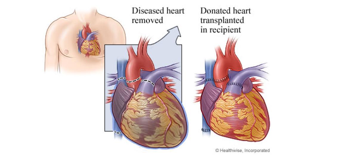 transplant
