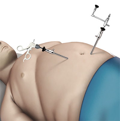 vsg surgery