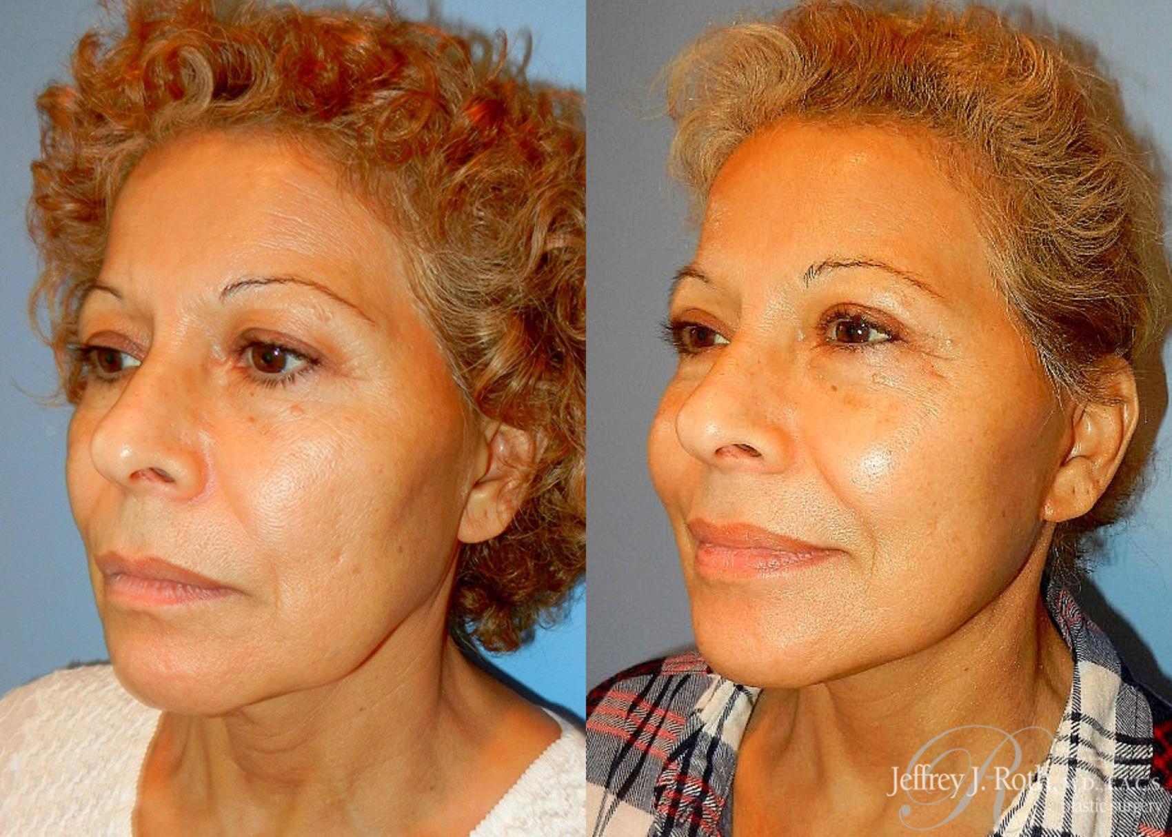 blepharoplasty cost