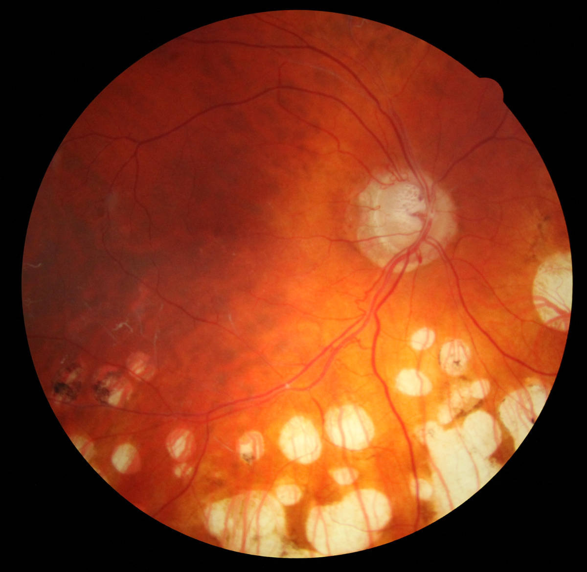 eye diseases