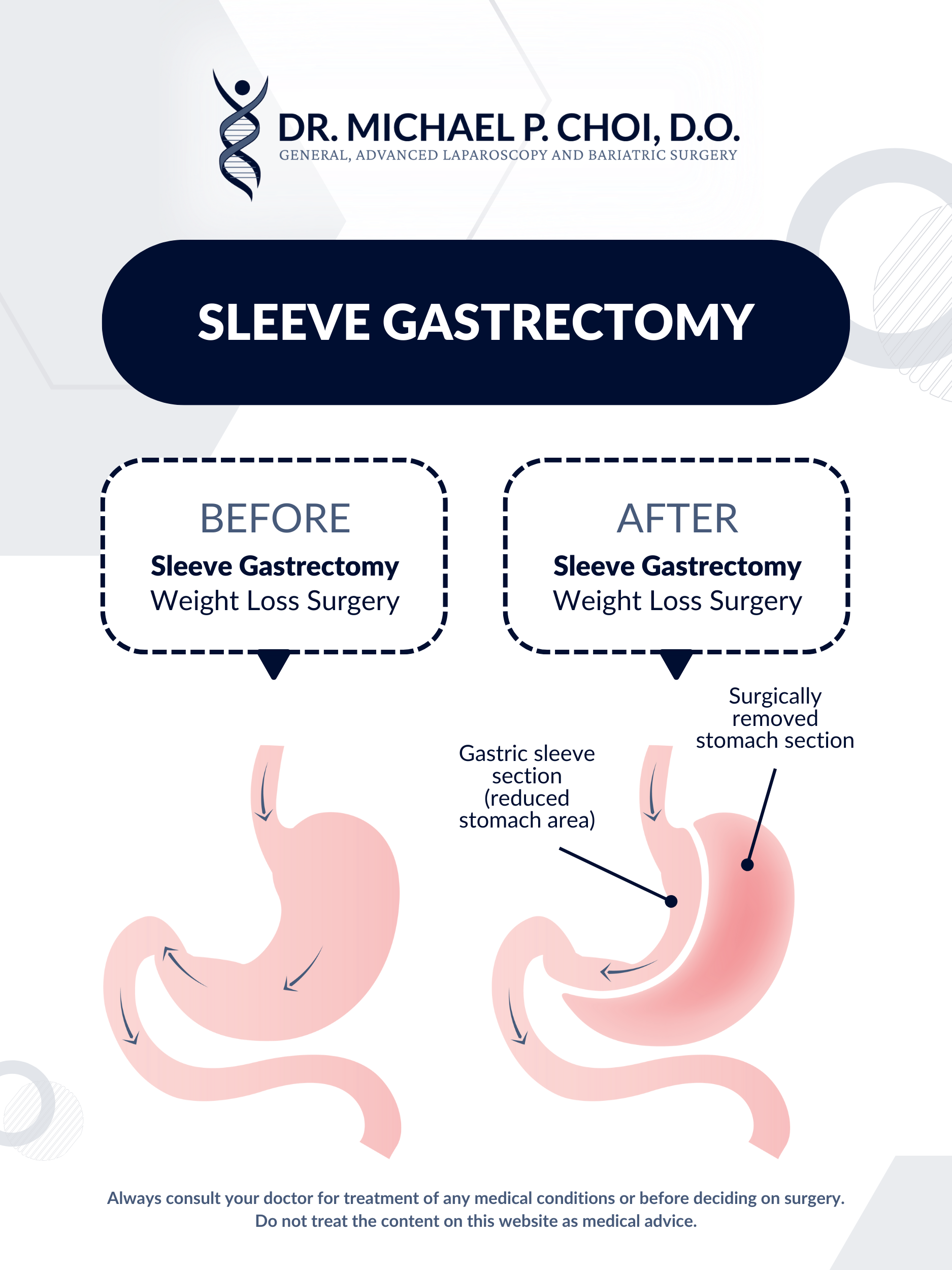 gastric sleeve surgery