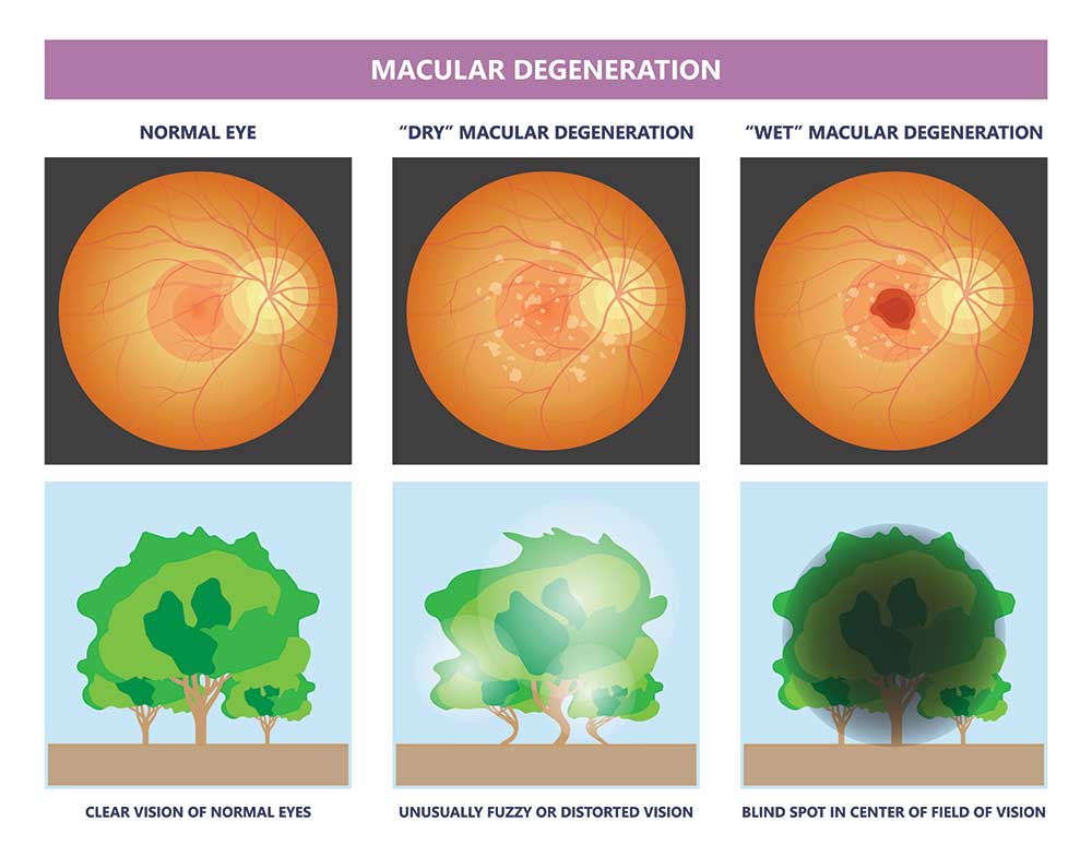 vision diseases