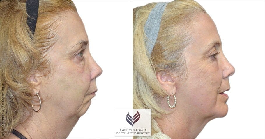 cosmetic surgery